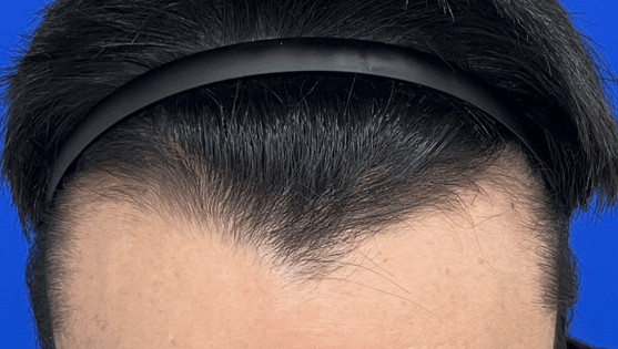 Pre-operative hairline photo showing a front whorl and cowlick before hair transplant