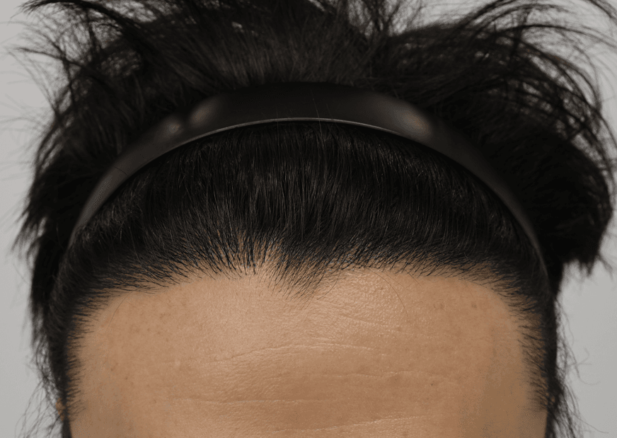 A case of hairline correction taking into account the front cowlick and the flow of existing hair