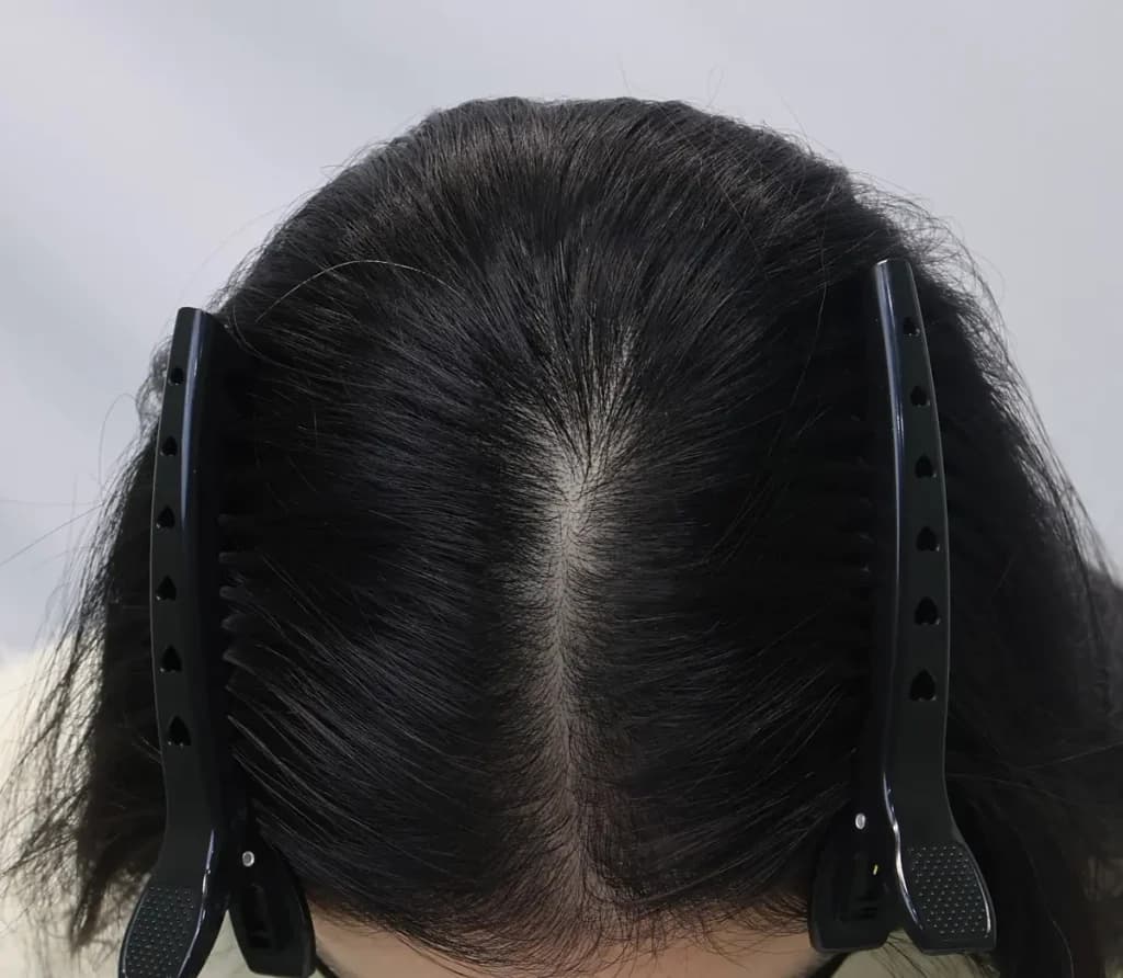 정수리 줄기세포치료 1년 1개월 경과 후 두피 상태