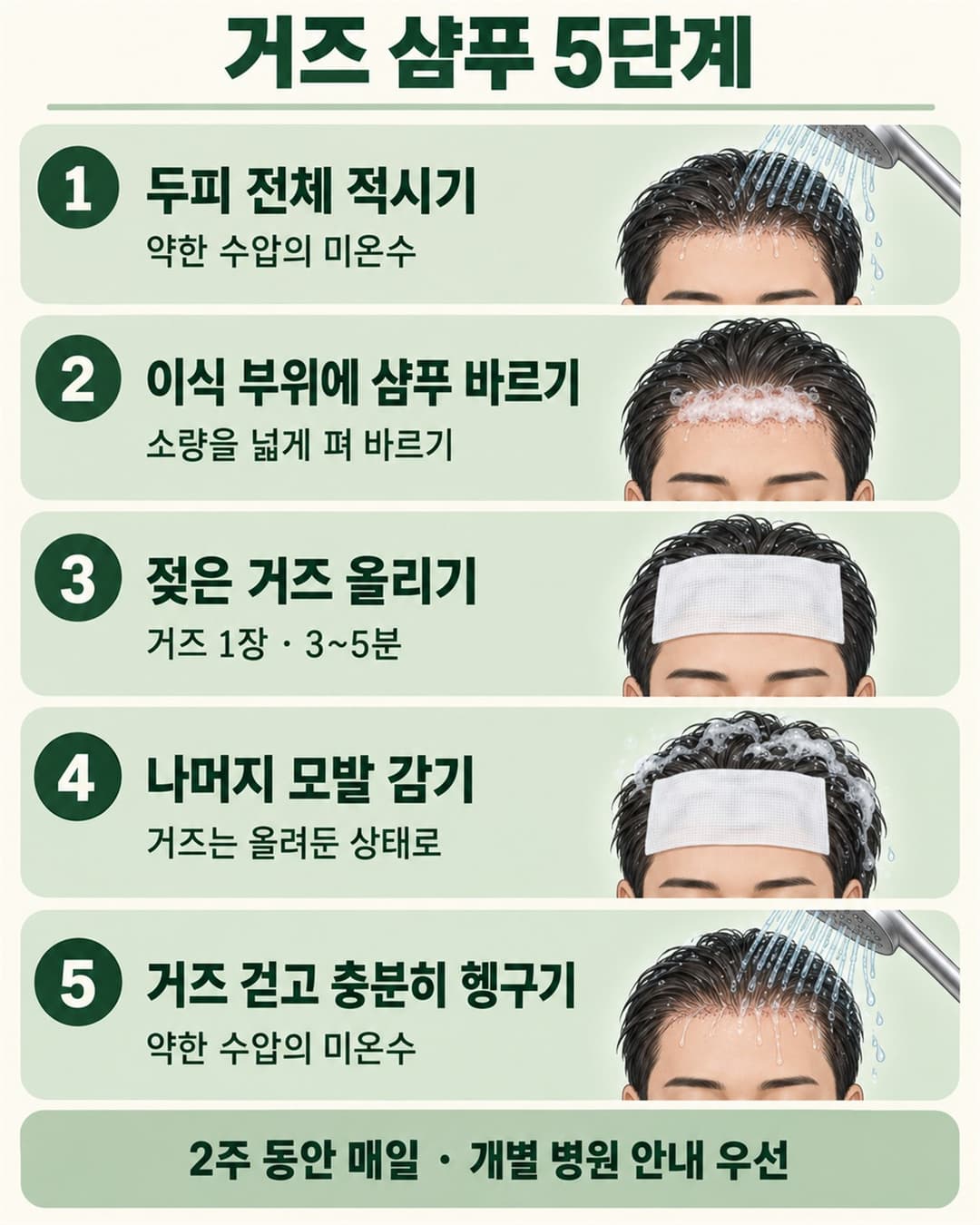 두피 적시기, 샴푸 바르기, 젖은 거즈를 3~5분 올리기, 나머지 모발 감기, 헹구기의 5단계