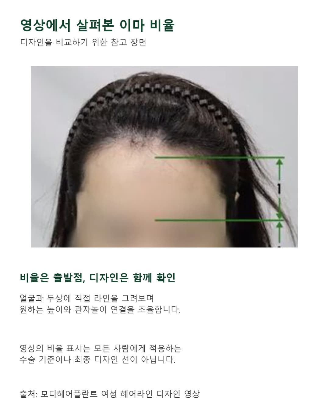 视频中女性案例的额头比例标示与发际线设计时的考虑要点