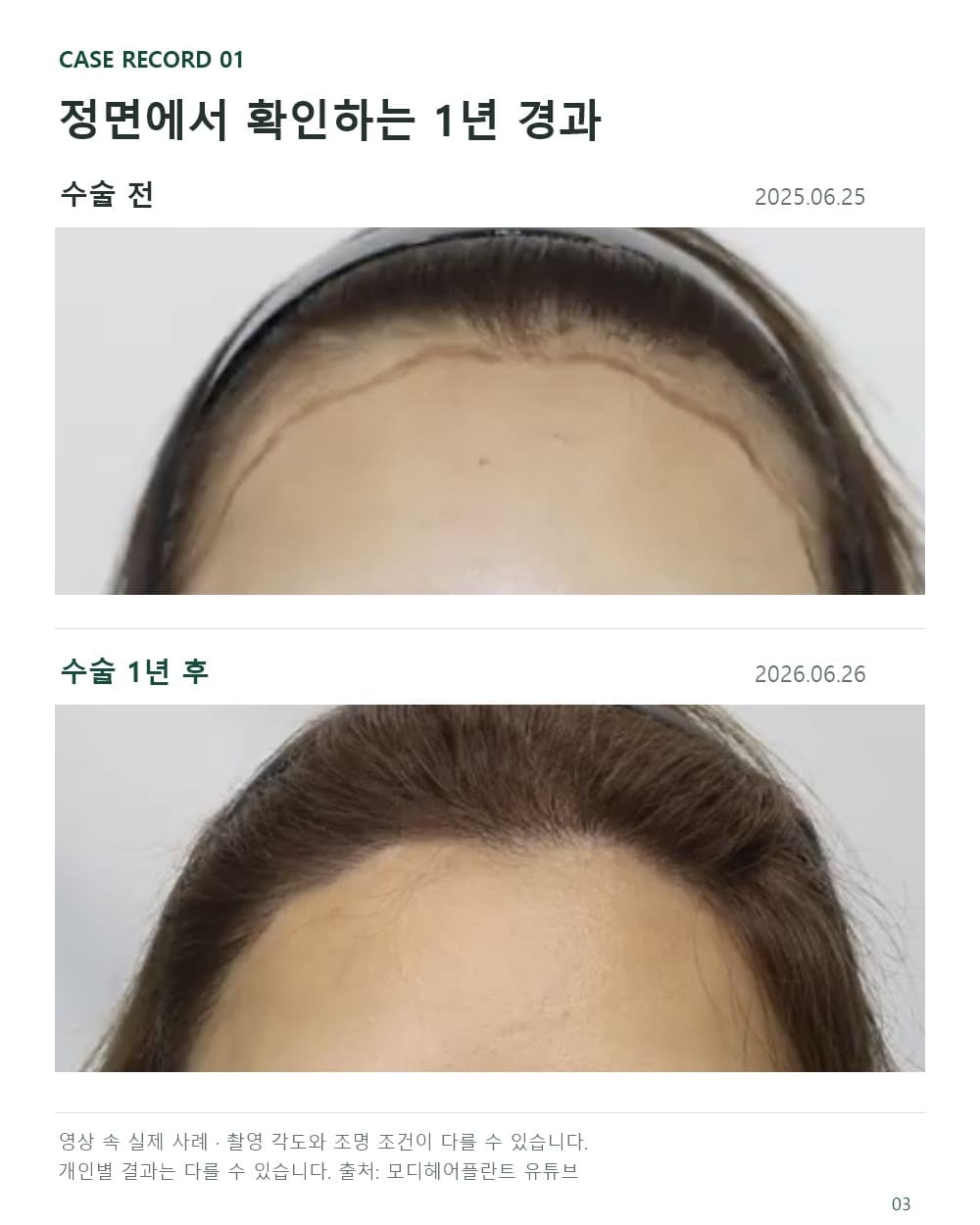 女性髮際線植髮案例於2025年6月25日術前與2026年6月26日術後1年的正面照片