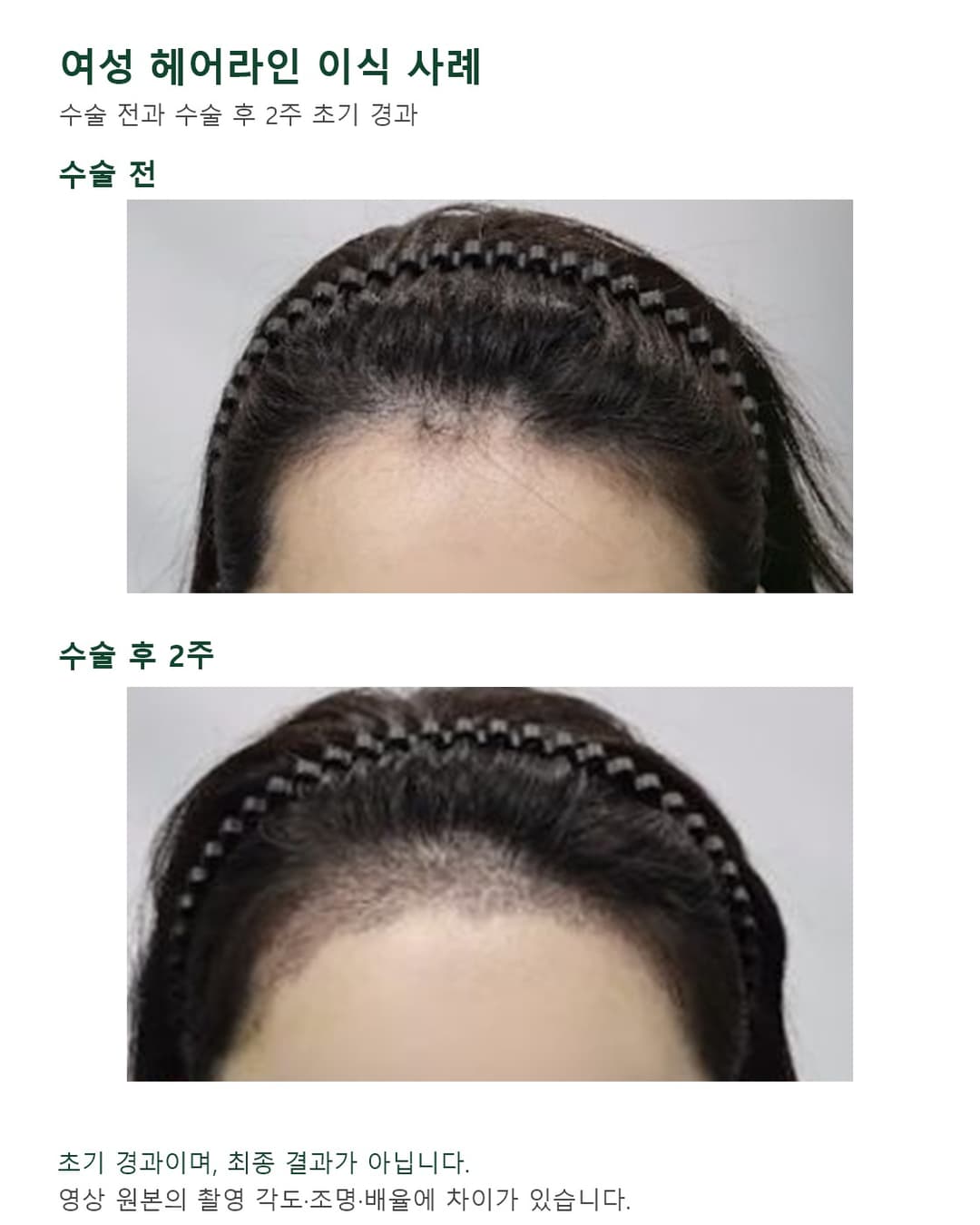 视频中40多岁女性发际线术前与约3500根移植后2周初期经过对比