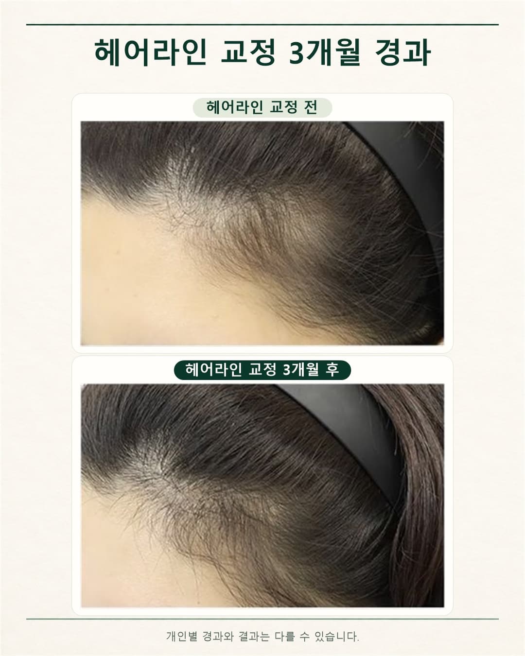 ヘアライン矯正前と矯正3か月後のサイドのヘアライン写真を上下に配置した経過比較