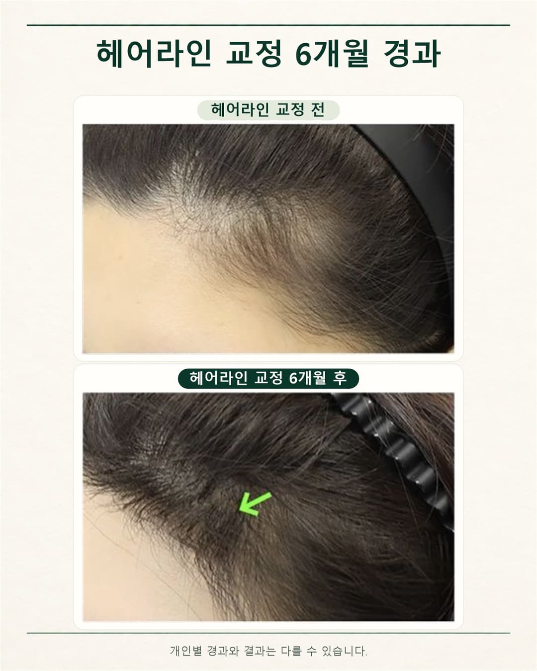 ヘアライン矯正前と矯正6か月後のサイドのヘアライン写真を上下に配置した経過比較