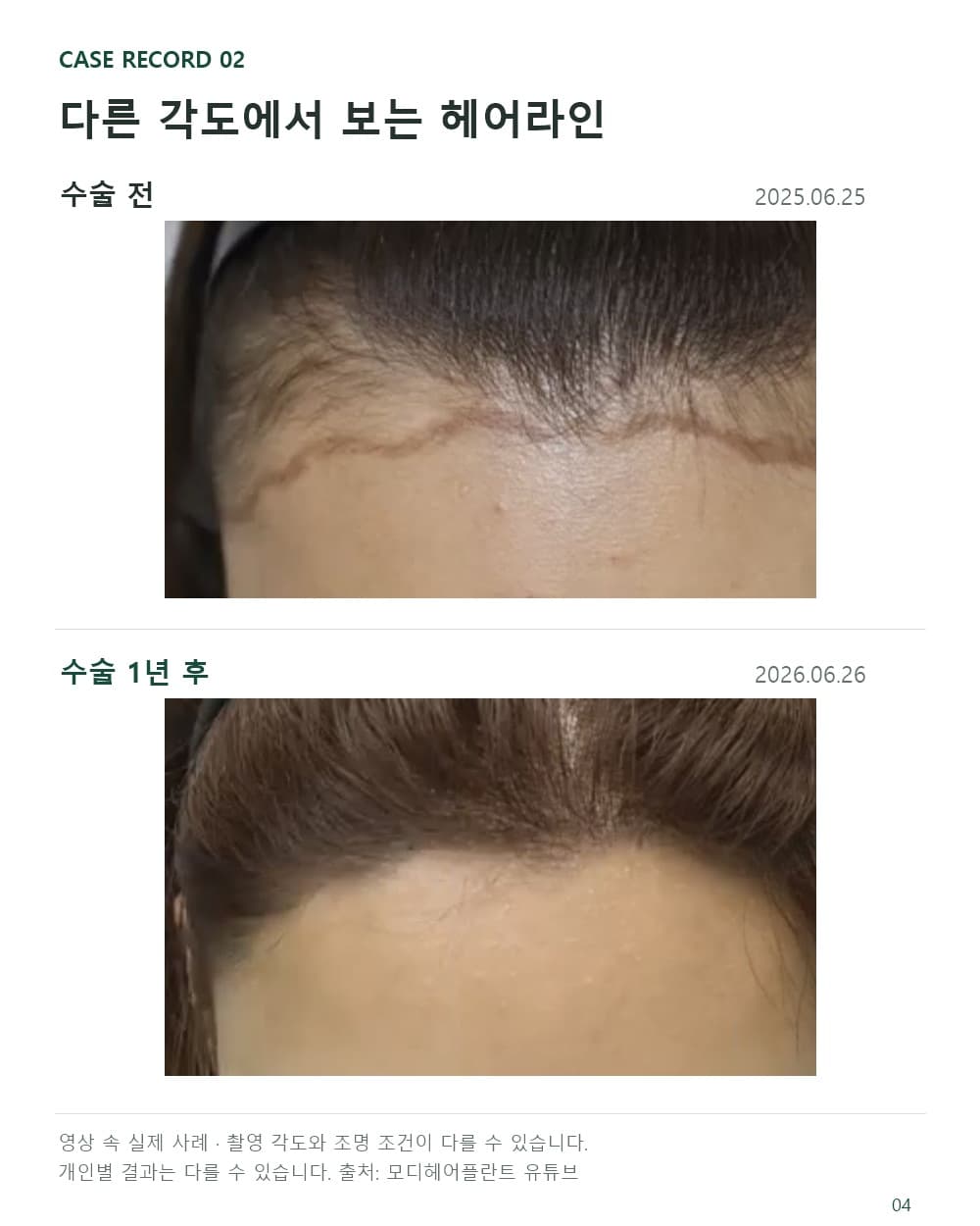 可觀察女性髮際線側邊銜接的術前與術後1年其他角度對比照片