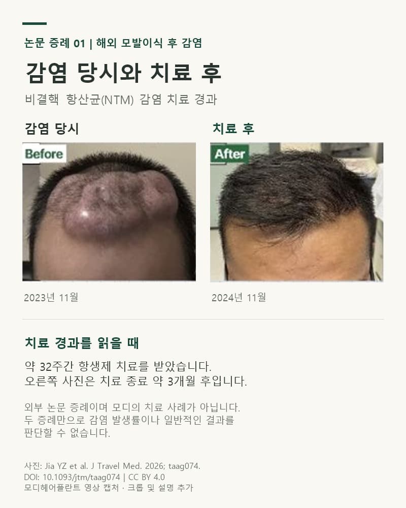 Comparison photos of the first patient in the paper: scalp infection in November 2023 and November 2024, about 3 months after completing antibiotic treatment