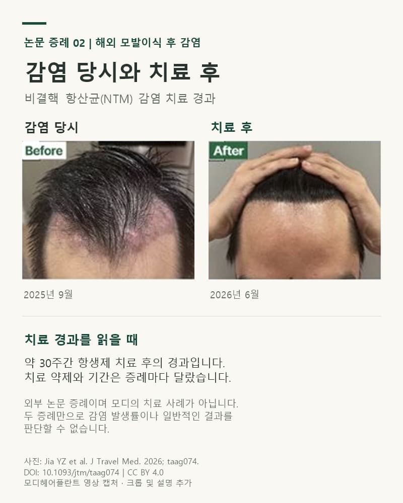 Comparison photos of the second patient in the paper: scalp infection in September 2025 and June 2026, after about 30 weeks of treatment