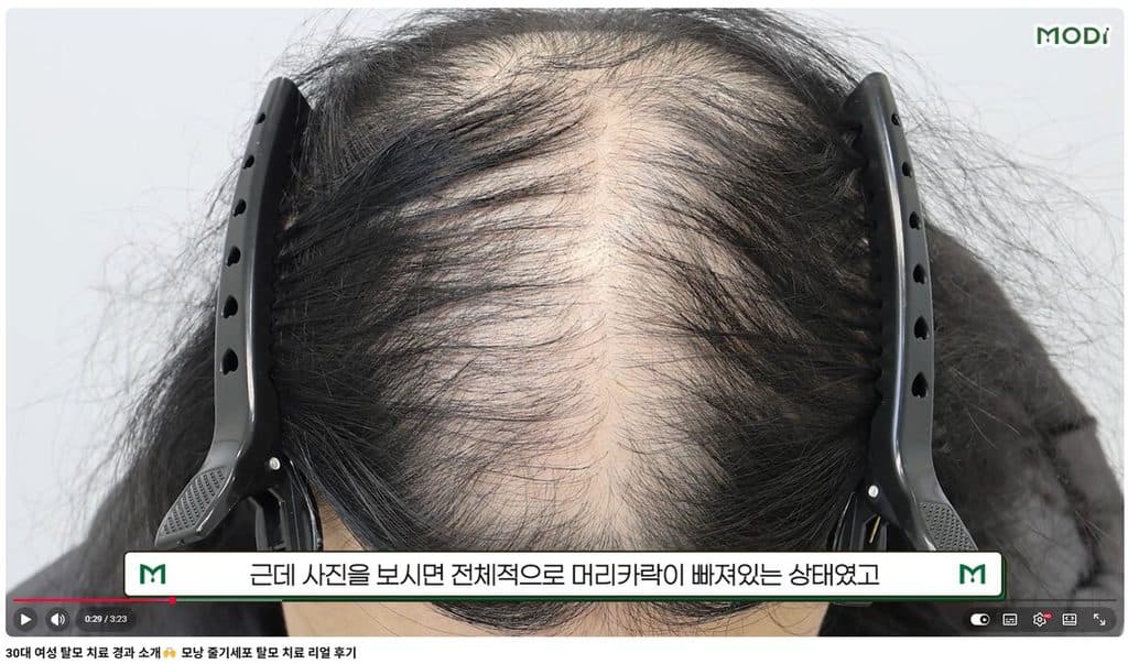 30대 여성 정수리 탈모 