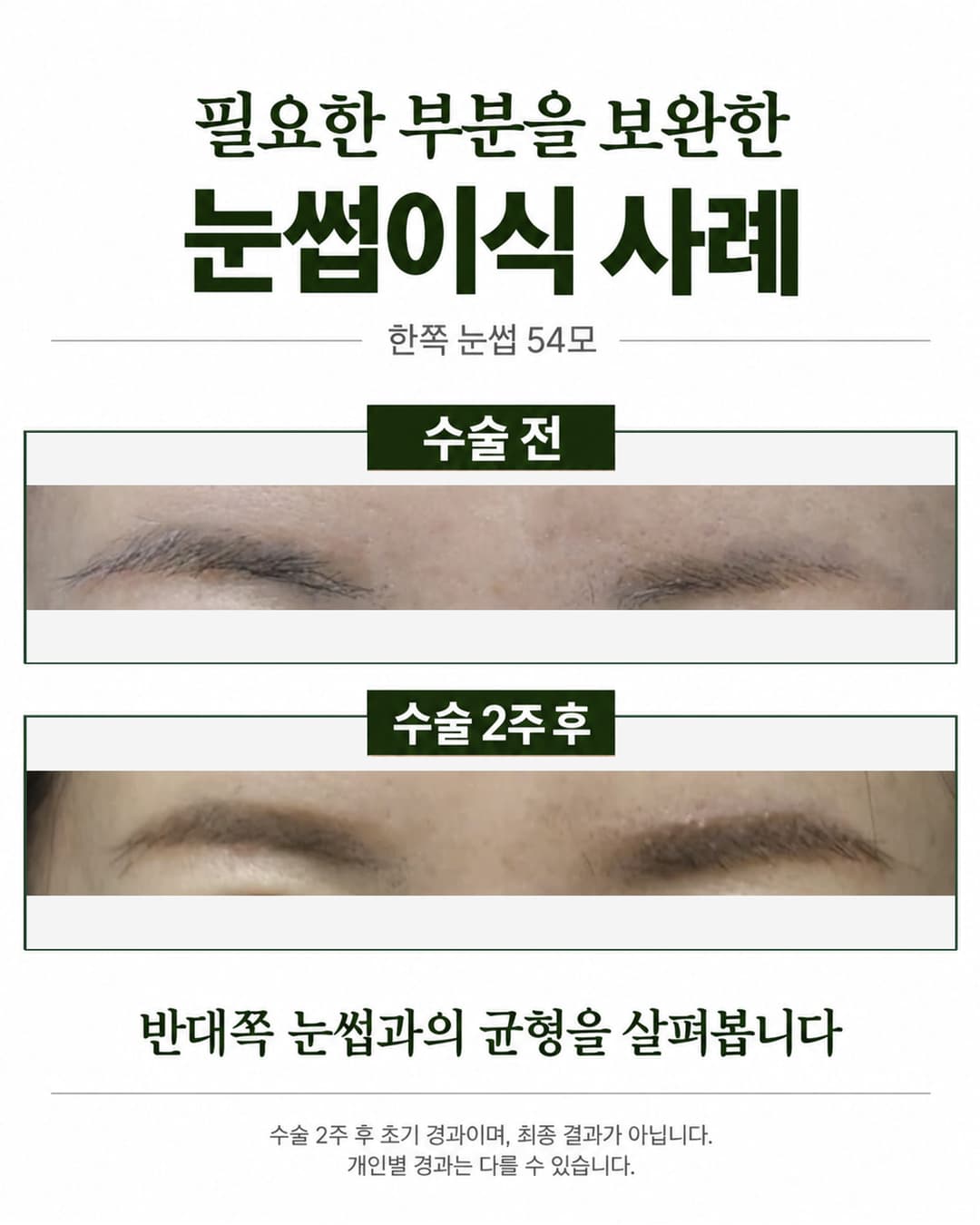 한쪽 눈썹 뒷부분이 부족했던 사례의 수술 전과 54모 이식 2주 후 초기 경과 비교