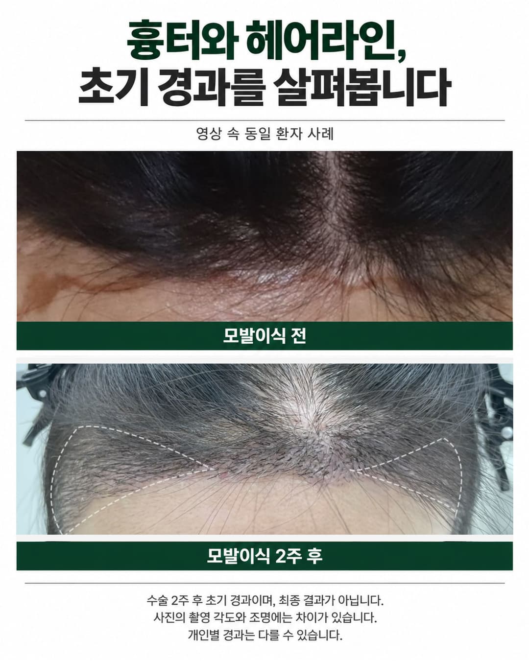 이마거상·이마축소 이력이 있는 환자의 모발이식 전과 수술 2주 후 헤어라인 초기 경과 비교