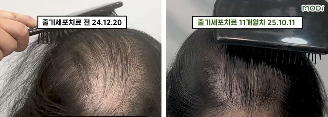 영상 속 30대 여성의 치료 전 2024년 12월 20일과 후기 경과 2025년 10월 11일 두피 사진 비교