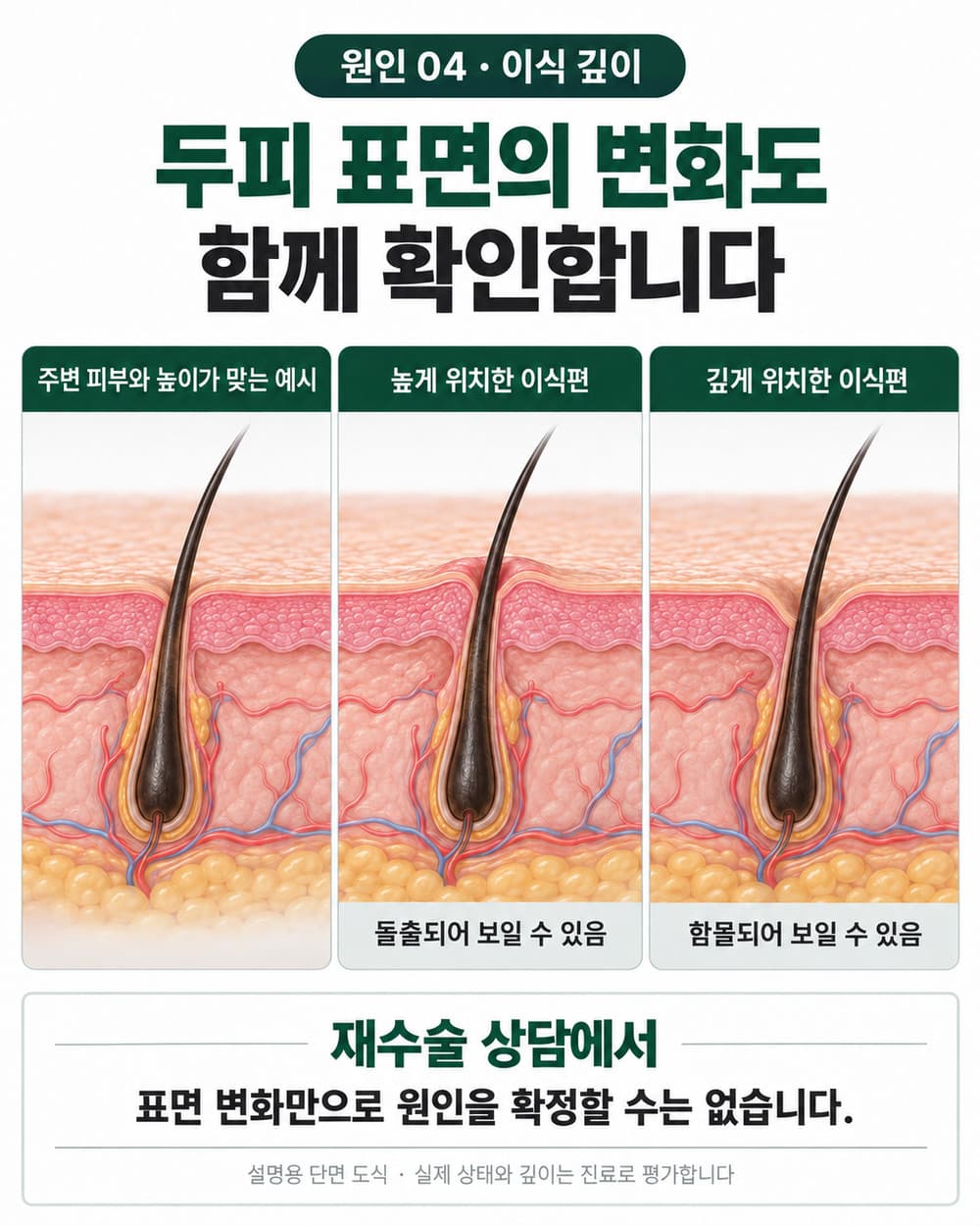 이식편이 높거나 깊게 위치할 때 나타날 수 있는 두피 표면의 돌출과 함몰을 설명하는 단면 도식