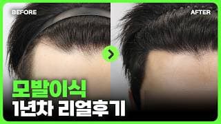 남자들의 최대 고민 M탈모, 헤어라인 모발이식 1년 후기