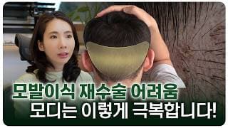 모발이식재수술 아무 데서나 하면 또 망합니다😂 모디가 재수술 맛집인 이유