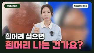 흰머리·백발도 모발이식이 될까? 실제 사례