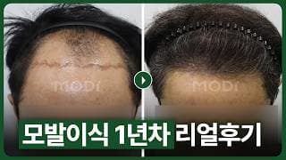 모발이식후기 1년차 어떻게 변할까? 중년 남자의 모발이식 전후비교