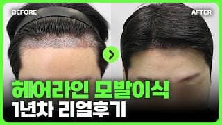 모발이식 1년 후 이렇게나 스타일이 좋아진다고 ?! #모발이식