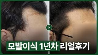 모발이식후기 [수술 통증·부기·일상 복귀는 언제?] 비절개 2600모 1년 전후 리얼 변화 공개!