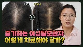 증가하는 여성 탈모, 이렇게 치료하세요