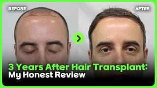 I did hair transplantation in Korea. What I look like after three years. ㅣ모발이식 3년차 후기