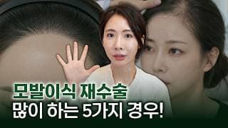 모발이식 재수술 고민하는 5가지 이유! 의사가 솔직하게 밝히는 모발이식 실패 원인과 예방법 총정리