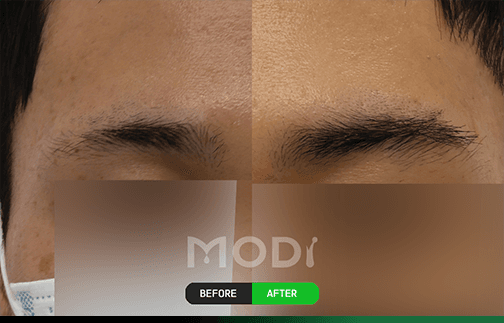 眉毛移植の前後比較 — 男性の眉毛 BEFORE/AFTER