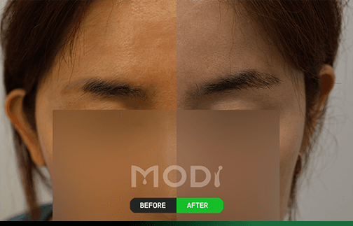 眉毛移植の前後比較 — 女性の眉毛 BEFORE/AFTER