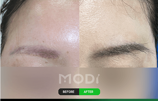 眉毛移植の前後比較 — 女性の眉毛 BEFORE/AFTER