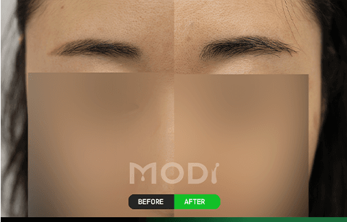 眉毛移植の前後比較 — 女性の眉毛 BEFORE/AFTER