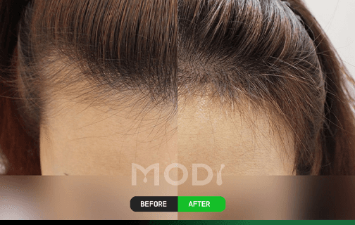 모발 방향 디자인 헤어라인 시술 전후 사례 4 — BEFORE/AFTER