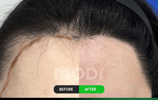 Hair-direction design forehead hairline procedure before/after case 5 — BEFORE/AFTER