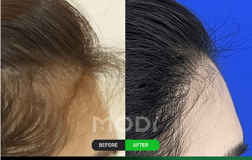 Hair-direction design side hairline procedure before/after case 6 — BEFORE/AFTER