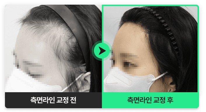 측면라인 교정 전과 후 비교 사진