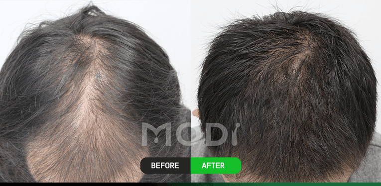 毛囊幹細胞治療前後對比 — 頭頂 BEFORE / AFTER
