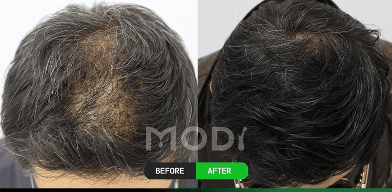 毛囊干细胞治疗前后对比 — 头顶 BEFORE / AFTER