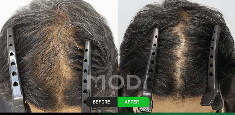 毛囊干细胞治疗前后对比 — 头顶 BEFORE / AFTER