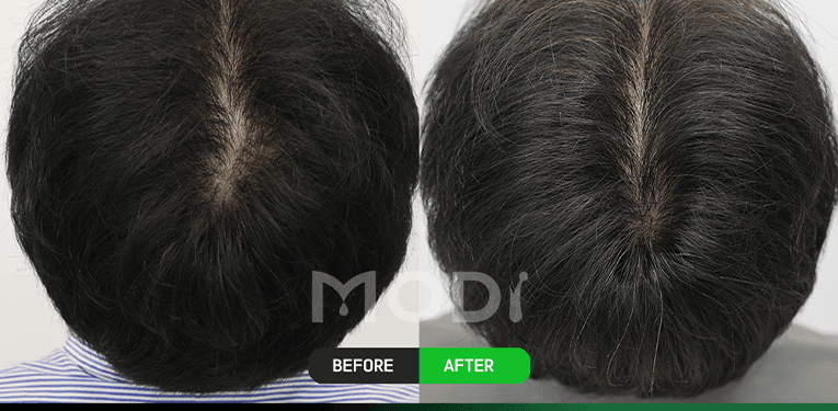 毛囊幹細胞治療前後對比 — 頭頂 BEFORE / AFTER