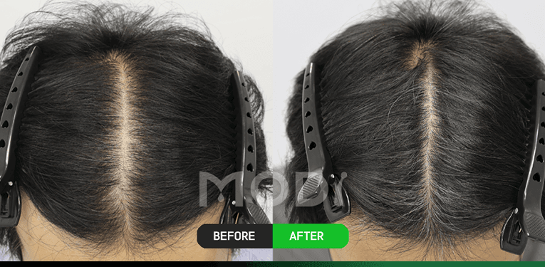 毛囊幹細胞治療前後對比 — 頭頂 BEFORE / AFTER