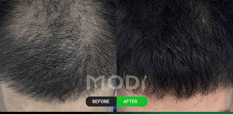 毛囊干细胞治疗前后对比 — 头顶 BEFORE / AFTER
