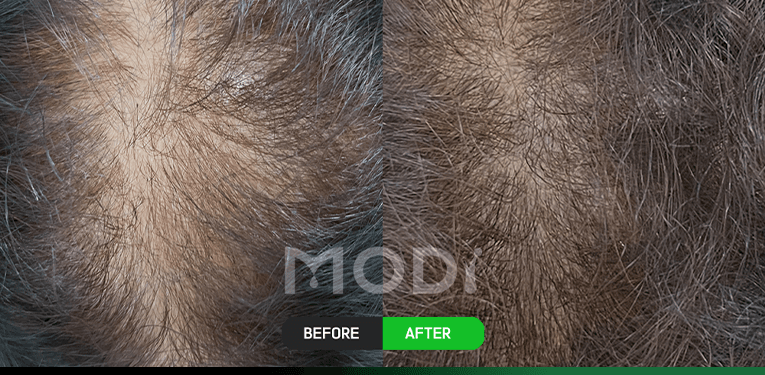 毛囊干细胞治疗前后对比 — 头顶 BEFORE / AFTER