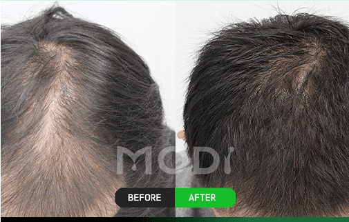 Revision surgery before-and-after comparison — top of the crown, showing an area where the scalp showed through before surgery improved after surgery