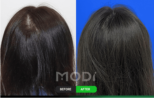 흉터이식 전후 비교 사진 — BEFORE / AFTER
