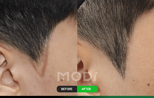 Before-and-after comparison photo of a sideburns hair transplant — BEFORE and AFTER side views