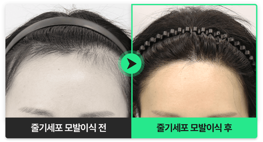 무삭발 비절개 모발이식 전후 비교 — 이마 헤어라인 모발 밀도 변화