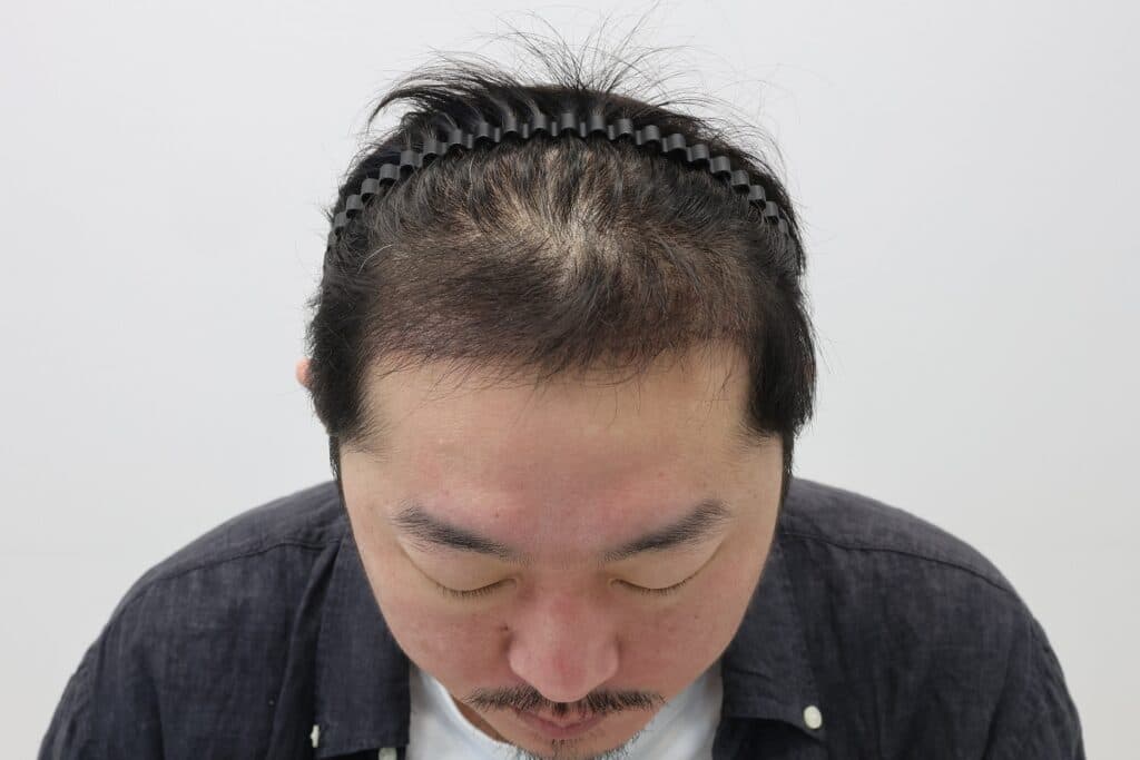 毛髪移植手術4ヶ月後の患者の写真