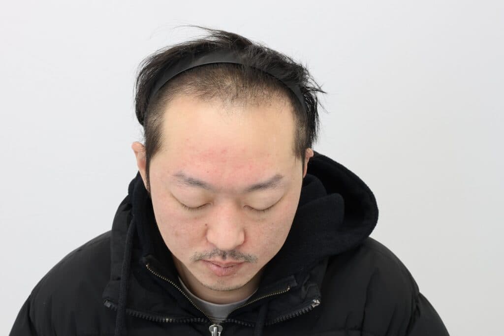 毛髪移植手術前の患者の写真