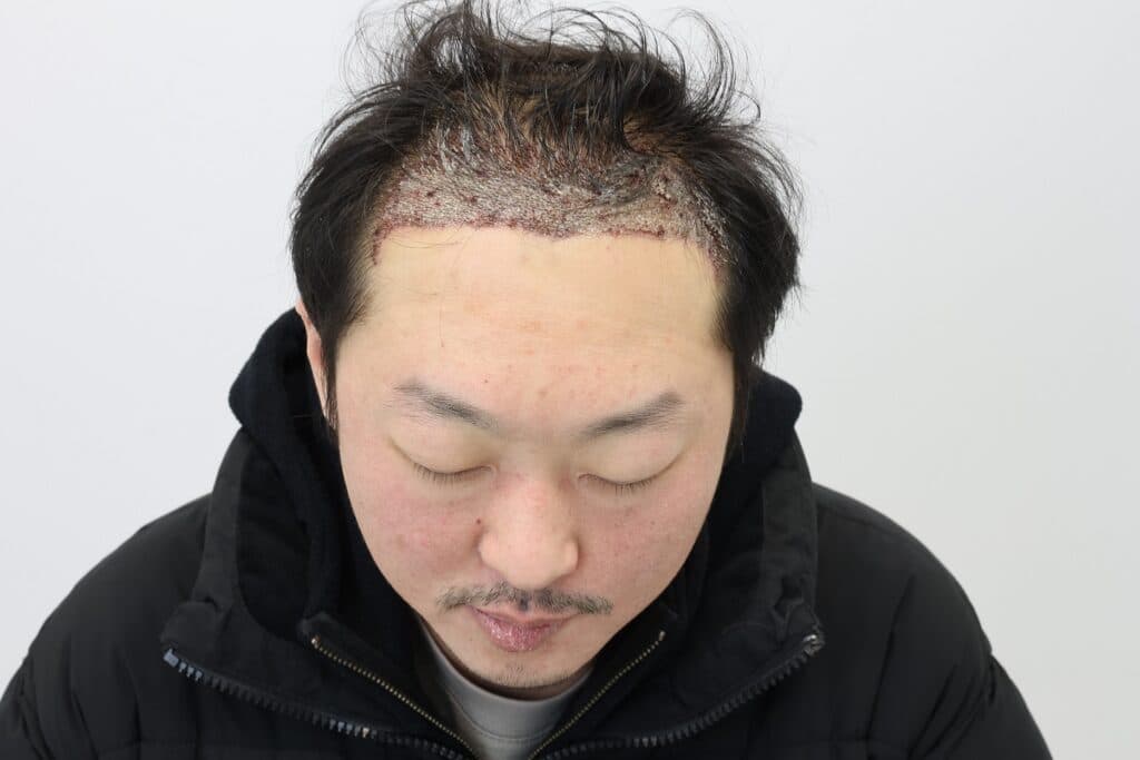 毛髪移植手術翌日の移植部位の写真
