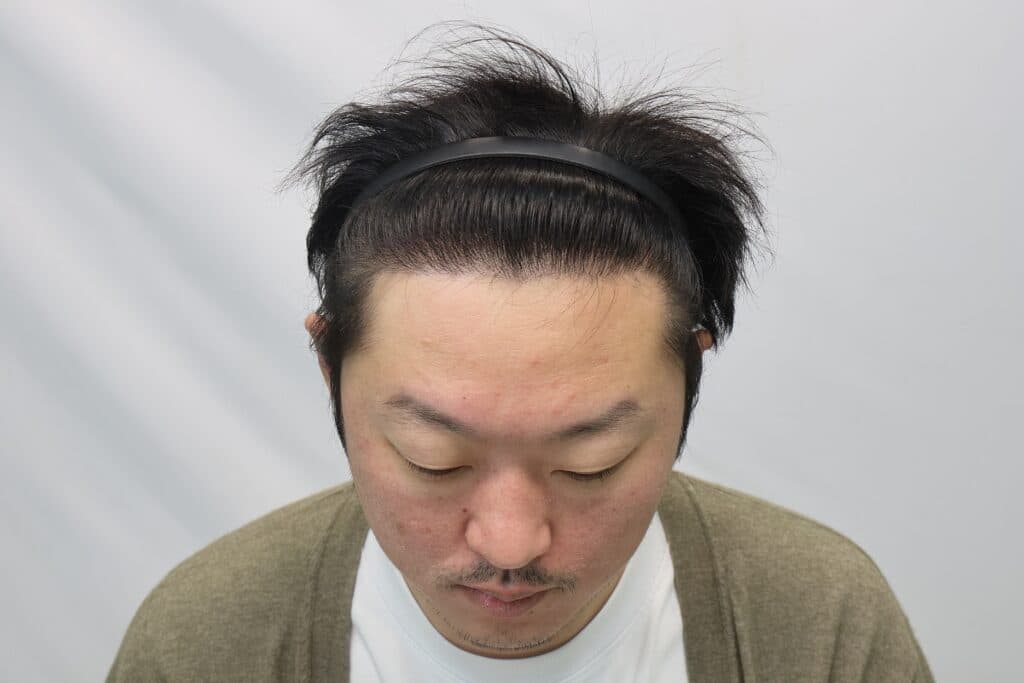 毛髪移植手術1年後の患者の写真