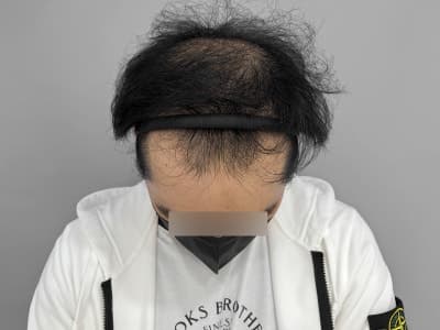 모발이식과 모낭줄기세포 치료 6개월 실제 사례중 치료전 사진
